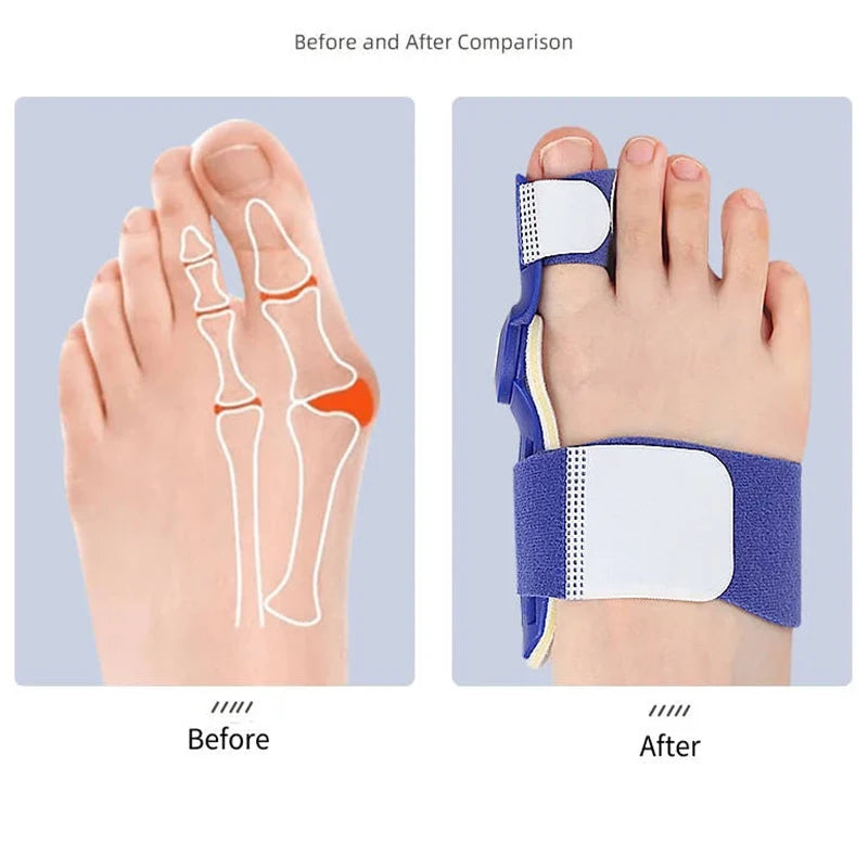 1/2pcs Bunion Splint Correction Adjustable Big Toe Corrector Braces Protector Hallux Valgus Straightener Foot Pain Relief